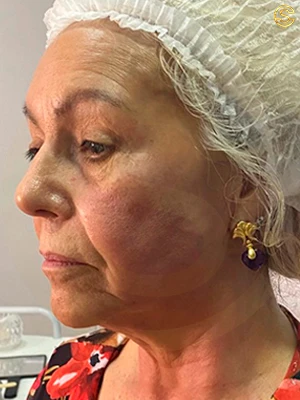 Foto antes e depois