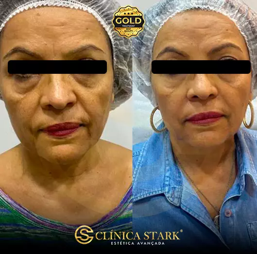 Foto antes e depois de lifting facial de uma mulher
