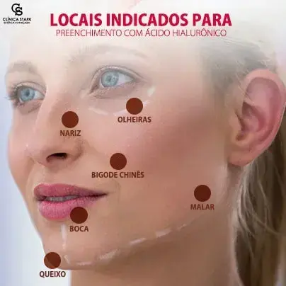 Locais na face que pode aplicar preenchimento com ácido hialurônico