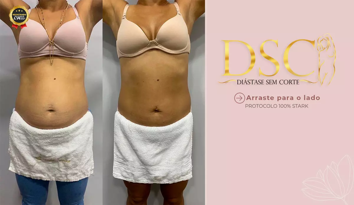 Tratamento de diástase abdominal (Diástase Off) Clínica Stark